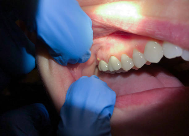 Best Emergency Dental Care for Abscessed Tooth in Kannapolis, NC